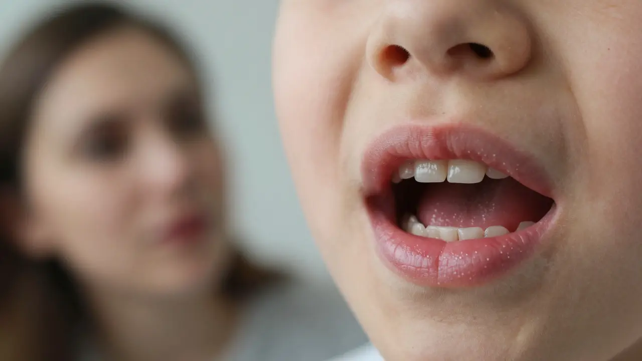Blízký záběr úst dítěte s drobnými bílými skvrnami na vnitřní straně líčka, charakteristický příznak spalniček.